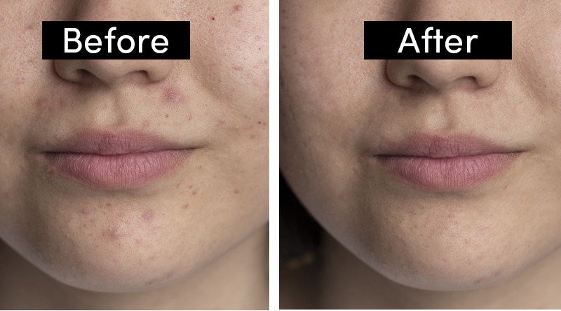 Tretinoin Cream Before and After